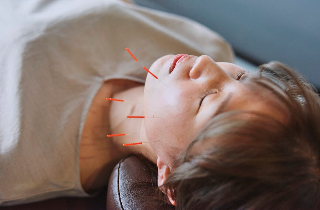 女性従業員が美容鍼灸を受けている写真